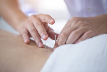 An acupuncturist placing small silver sticks into the lower back of a client who is lying down under a towel.