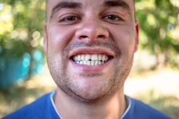 A close-up of a smiling man in a blue shirt showing a chipped front tooth against a blurred background.